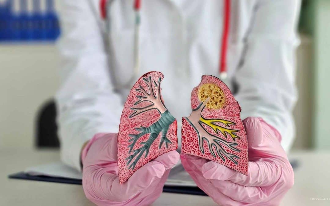 UMS Ditunjuk Jadi Co-Anchor Konsorsium Penanggulangan TBC di Kota Surakarta